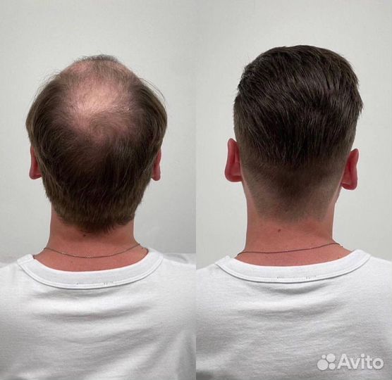 Установка систем замещения волос