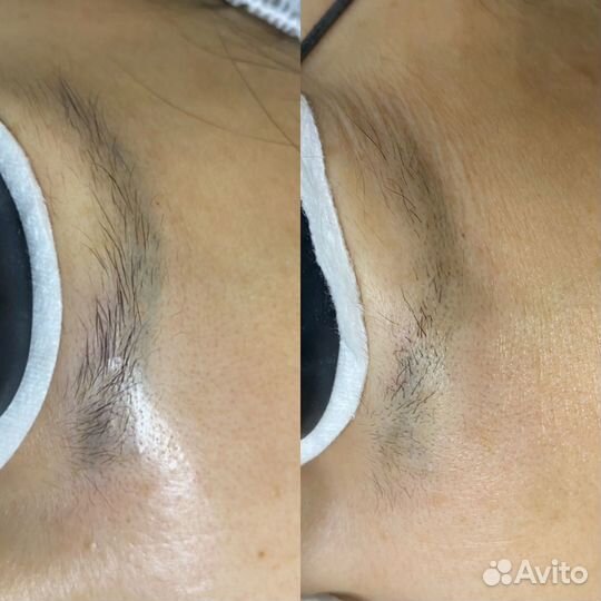 Удаление татуажа и тату лазером