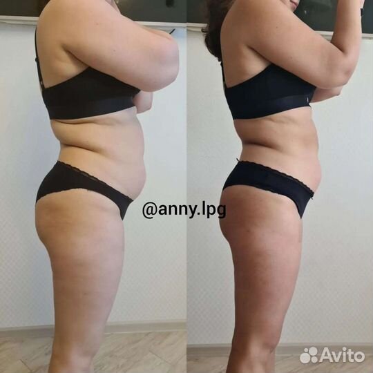 Антицеллюлитный массаж