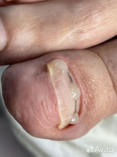 Установка коррекционной ситемы титановая нить