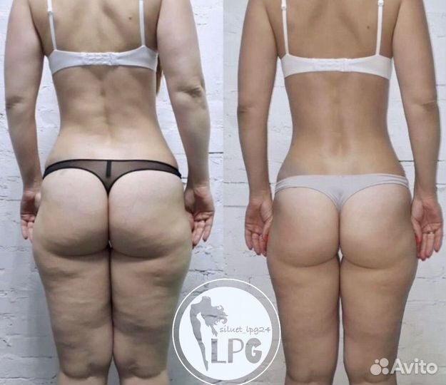 Аппаратный массаж LPG Курсы похудения