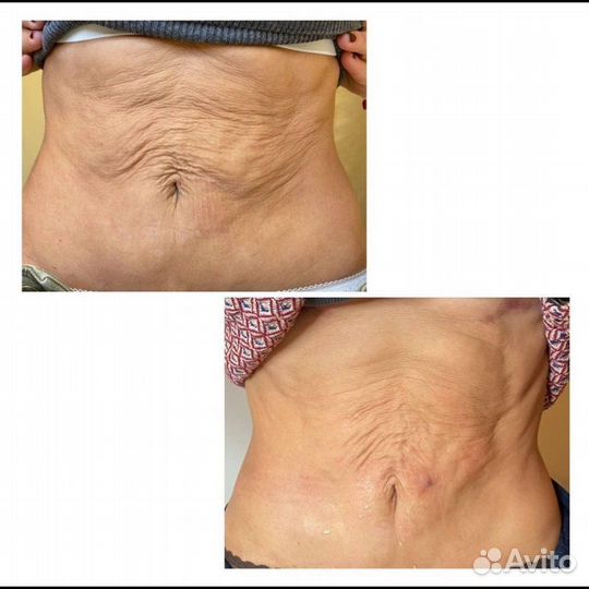 Холодная плазма.Омоложение