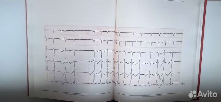 Атлас электрокардиограмм, аритмии и блокады сердца