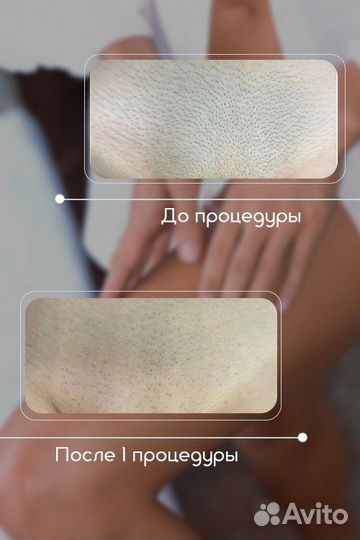 Студия лазерной эпиляции