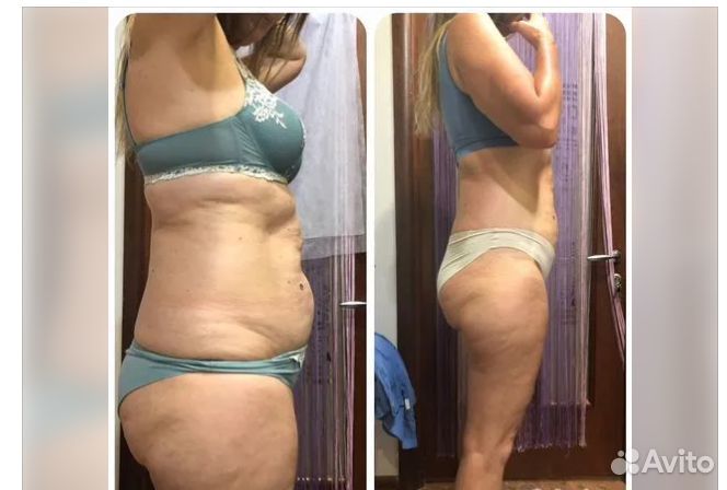 Липосакция без операции в Тольятти