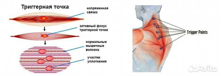 Лечение межпозвоночной грыжи,Миофасциальный массаж