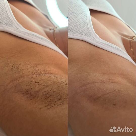 Депиляция, шугаринг. Парк Победы