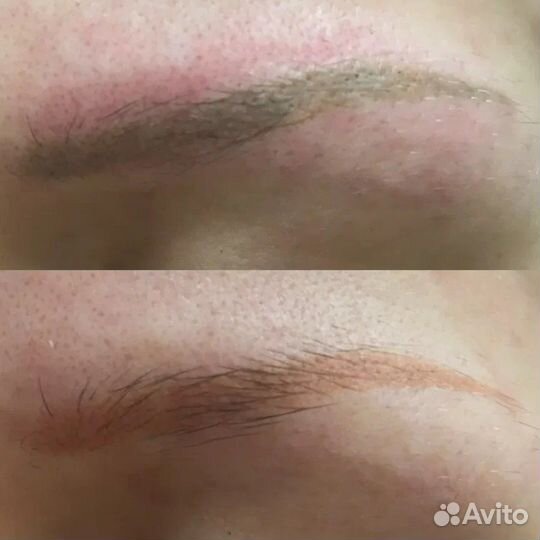 Удаление татуажа лазером