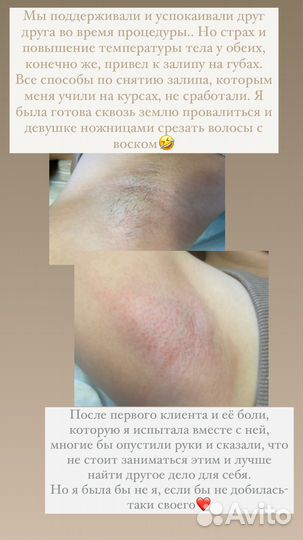 Депиляция