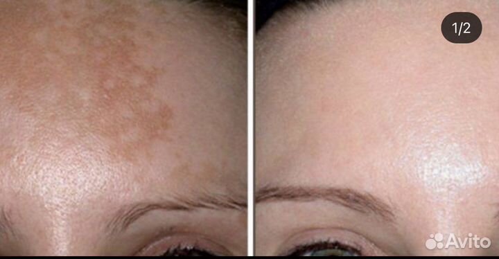 Лазерное удаление татуажа и тату