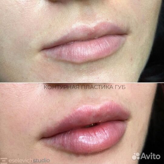 Ищу модель на контурную пластику губ