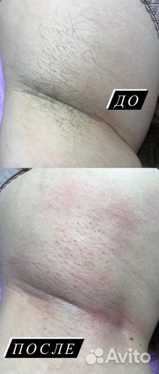 Восковая депиляция