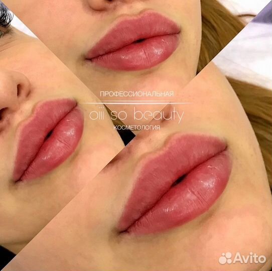 Увеличение губ, увлажнение 0,5мл, 1мл