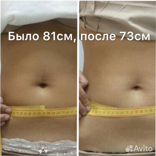 Похудение. Безоперационная липосакция. Целлюлит