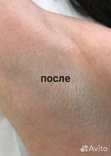 Микроигольчатый РФ лифтинг