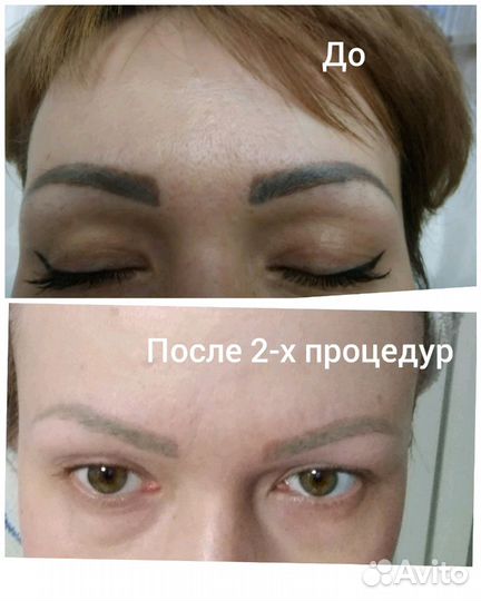 Лазерное удаление татуажа, тату