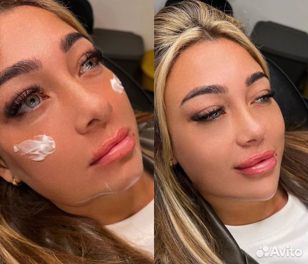 Контурная пластика моделирование лица