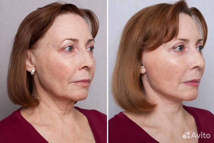 Массаж лица. Омоложение без уколов. Эффект сразу