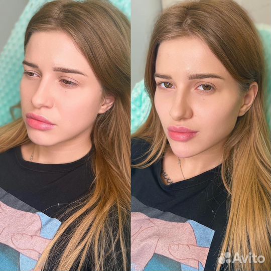 Косметолог. Контурная пластика, лицо под ключ