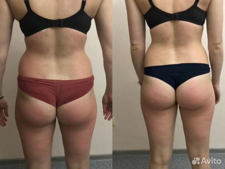 Массаж/Lpg массаж/антицеллюлитный массаж