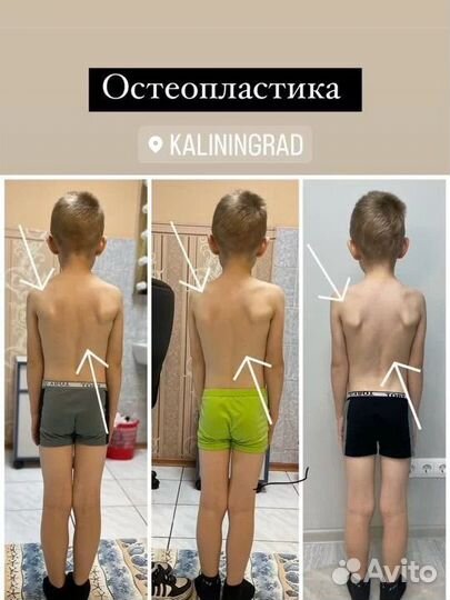 Остеопластика (остеопатический массаж)