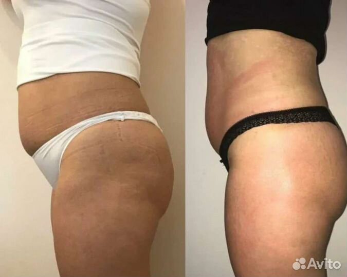 Ультразвуковая кавитация, RF лифтинг