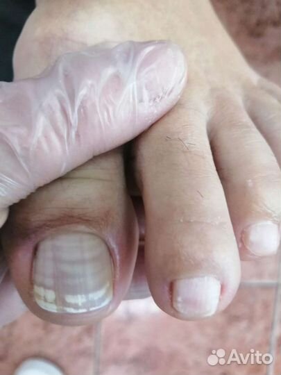 Подолог. Педикюр лечебный /мужской /женский/детски