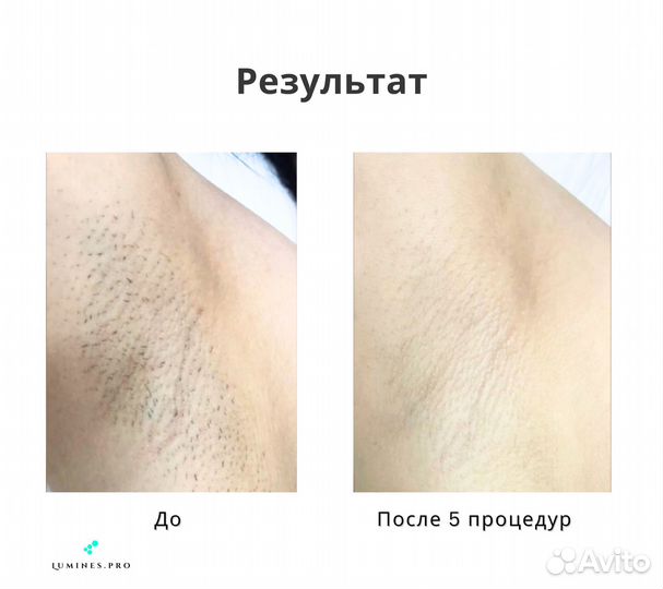 Аппарат для эпиляции Лю-Минес Max Pro 2000W