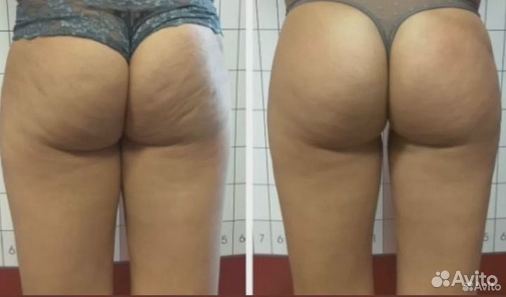 Аппаратный массаж / коррекция фигуры