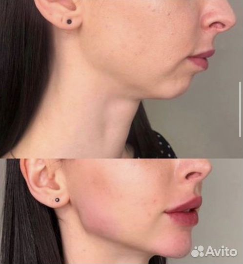 Косметолог нити губы ботокс лазер игольчатый РФ