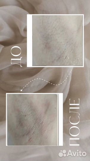 Лазерная эпиляция