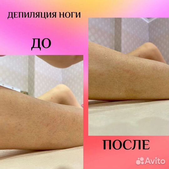 Шугаринг