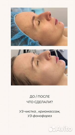 Косметолог Чистка лица Аппаратная косметология