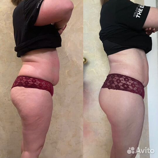 Антицеллюлитный массаж Аппаратный массаж