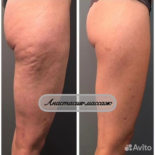 Антицеллюлитный массаж