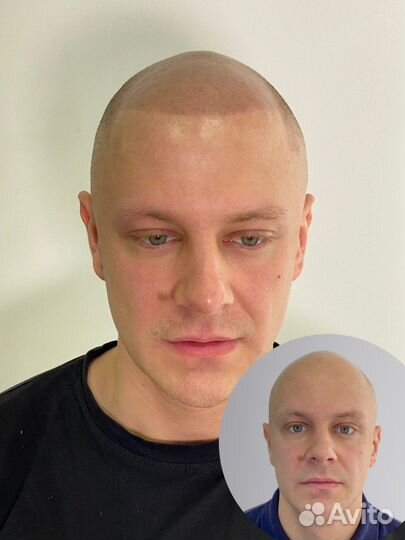 Трихопигментация головы