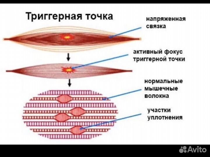 Миопрессура, глубокий массаж