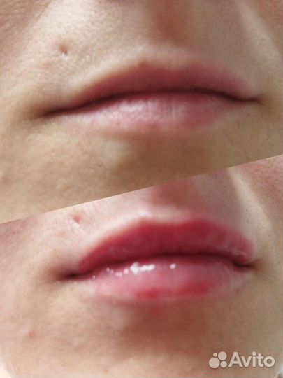 Косметик-эстетист, Увеличение губ без иглы и боли