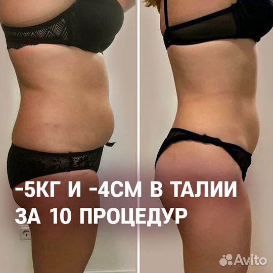 LPG массаж -6,5 кг за курс, м. Парнас