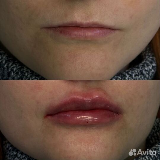 Увеличение губ плоский бант