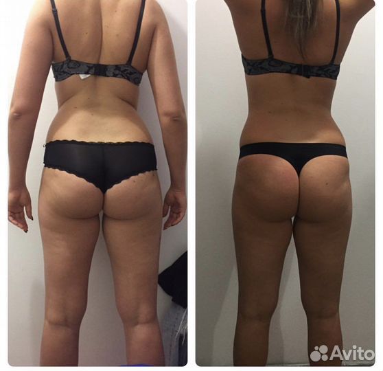 Антицеллюлитный массаж ручной