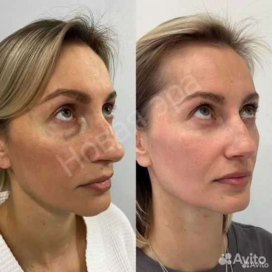 Игольчатый РФ лифтинг. Morpheus 8