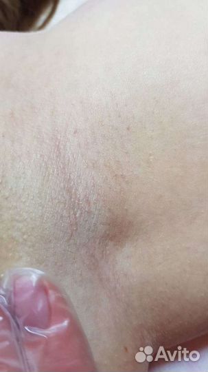 Депиция сахар/воск