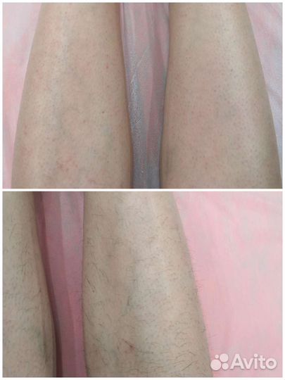 Шугаринг: подмышки