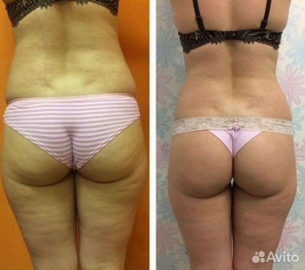 Массаж. Антицеллюлитный массаж. Коррекция фигуры