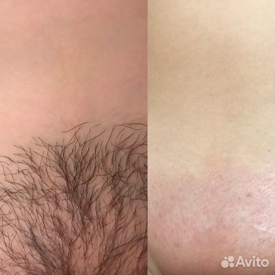 Депиляция - сахар/ воск. кмр