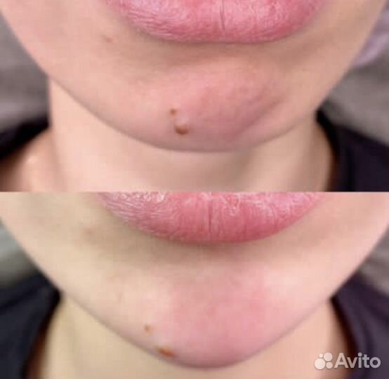 Биоревитализация