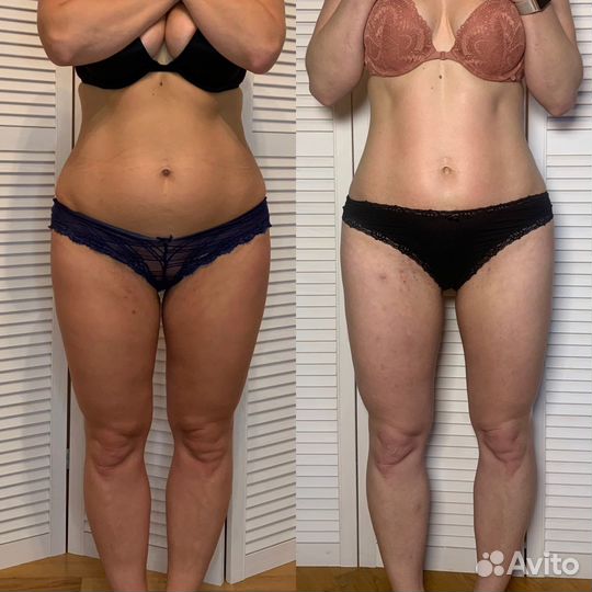 Антицеллюлитный массаж,Коррекция фигуры