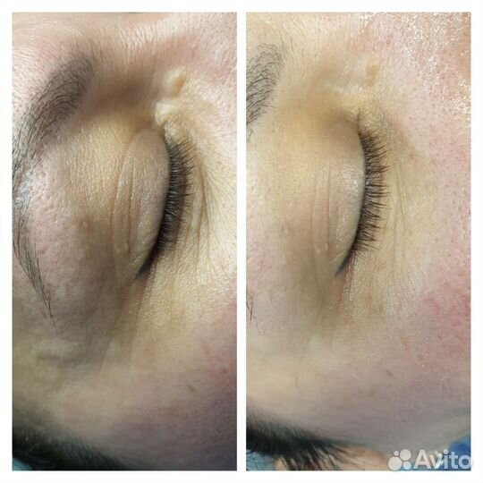 Скульптурный массаж лица