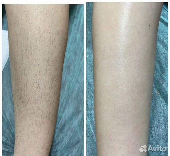 Депиляция воском: глубокое бикини